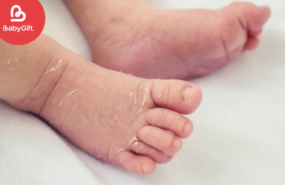 วิธีดูแลทารกผิวแห้ง