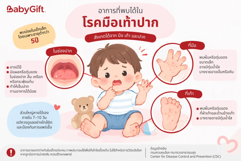 อาการและจุดสังเกตุโรคมือเท้าปาก